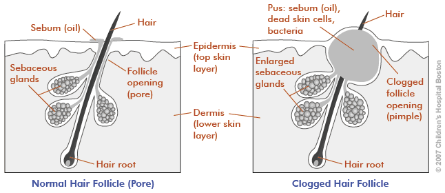 acne scheme